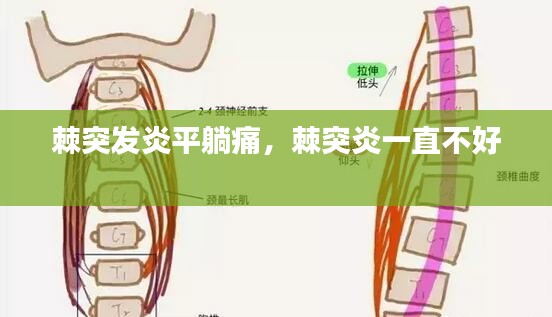 棘突发炎平躺痛，棘突炎一直不好 