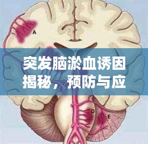 突发脑淤血诱因揭秘，预防与应对措施