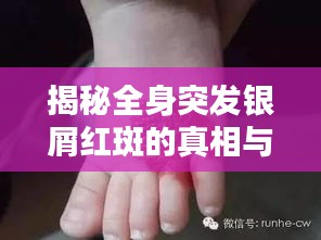 揭秘全身突发银屑红斑的真相与原因解析